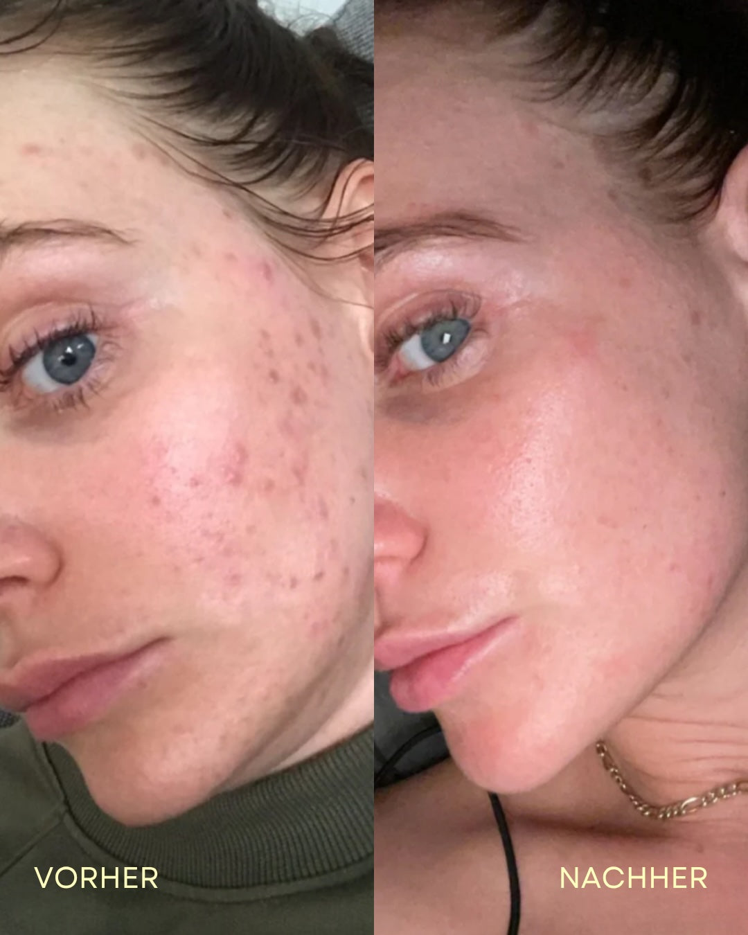 SKIN CLEAR CAPS - Hautreinheit & Hormonbalance