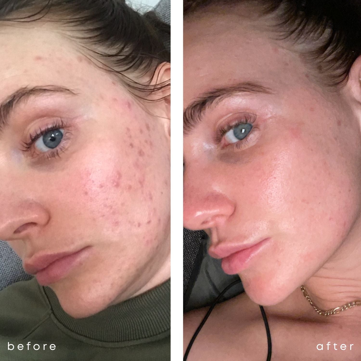 SKIN CLEAR CAPS - Hautreinheit & Hormonbalance