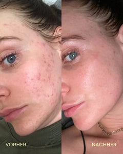 SKIN CLEAR CAPS - Hautreinheit & Hormonbalance